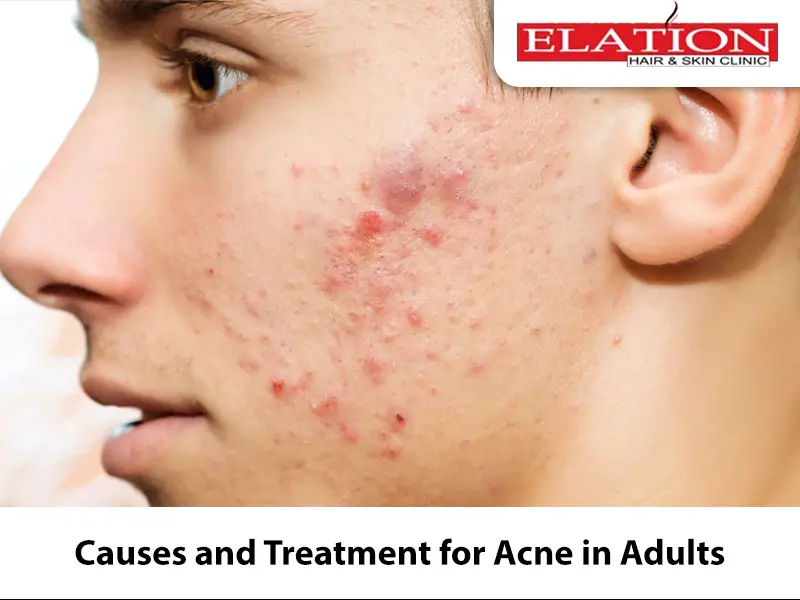 Causes and Treatment for Acne in Adults