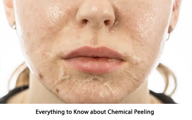 Everything to Know about Chemical Peeling