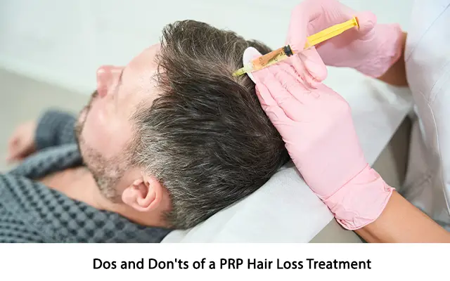 Dos and Don’ts of a PRP Hair Loss Treatment