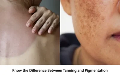 Know the Difference Between Tanning and Pigmentation