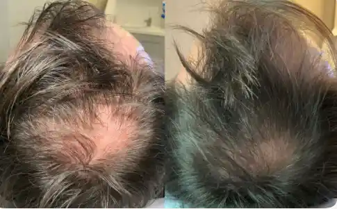 What is the success rate of Exosome therapy?