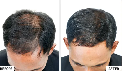 PRP Treatment, Elation