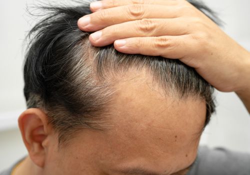 Non-Surgical Hair Replacement