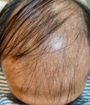 who needs the treatment