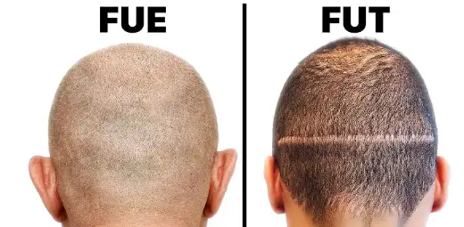 Surgical Options for Severe Hair Loss