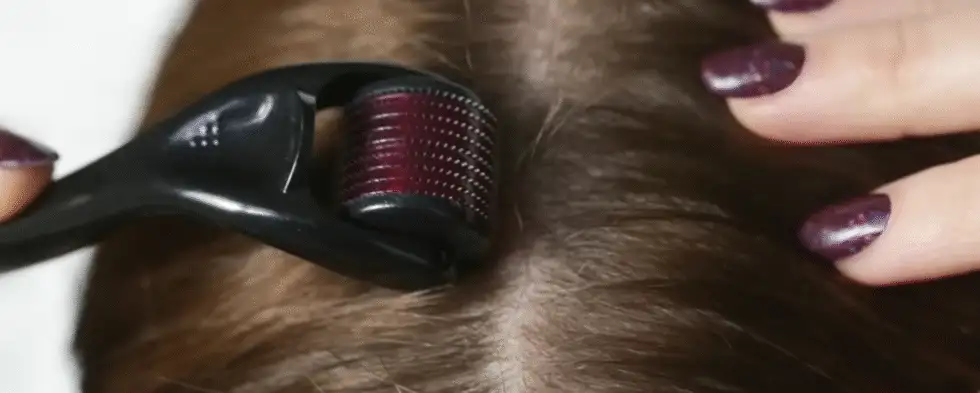 Microneedling with Growth Factors