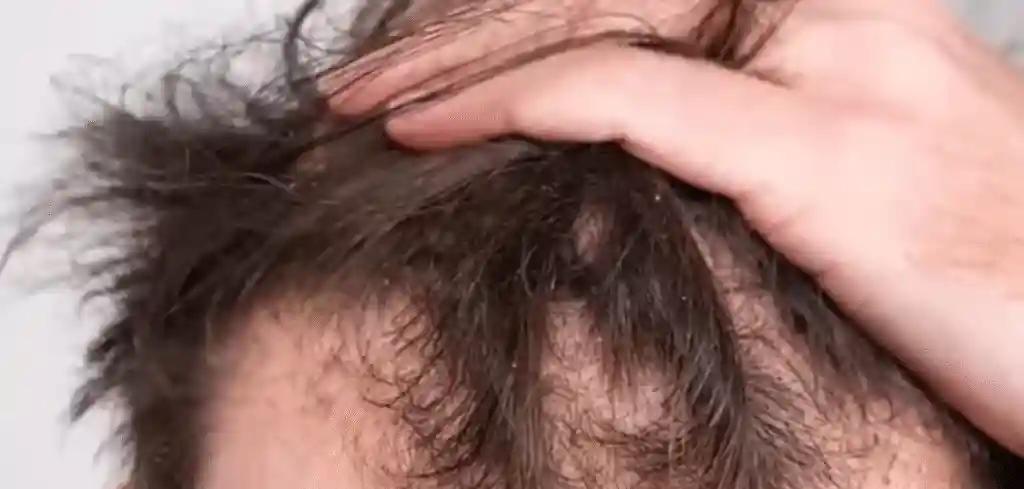 Common Causes of Hair Loss