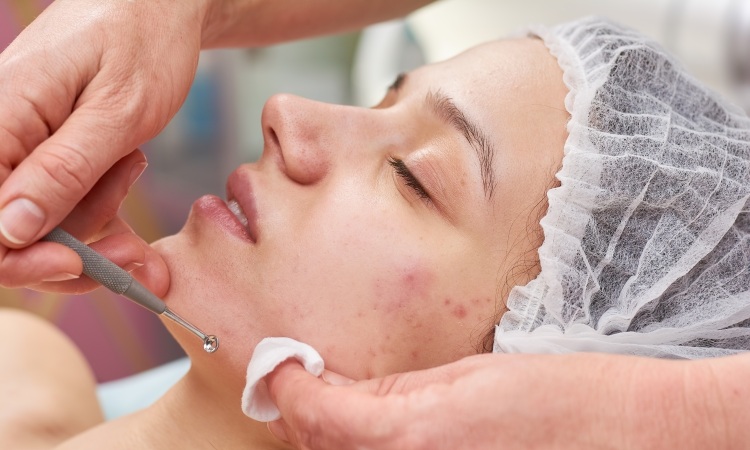 Acne Scars Treatment