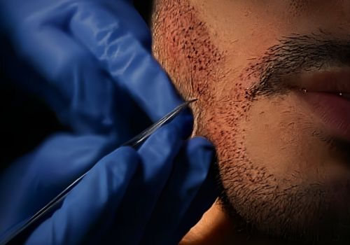 Beard Transplant Process
