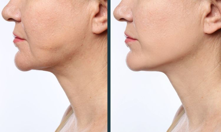 Chin Sculpting