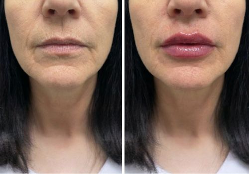 Dermal Fillers Transformation
