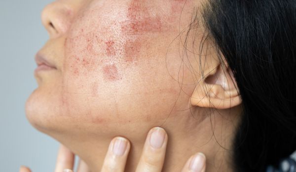 who needs the treatment