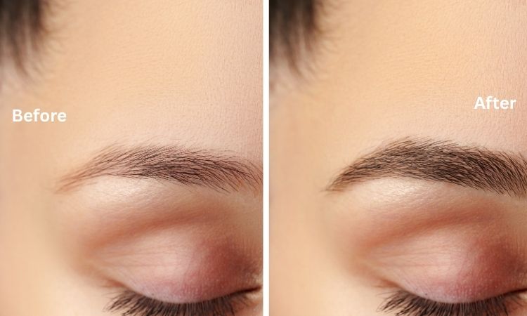 Eyebrow Transplant result