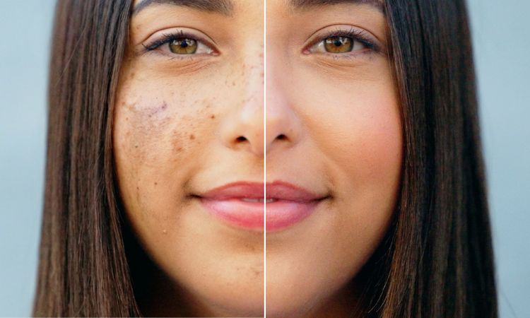 Hydrafacial Transformation