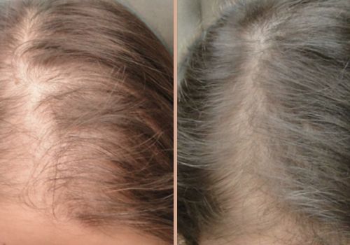 Mesotherapy before & after
