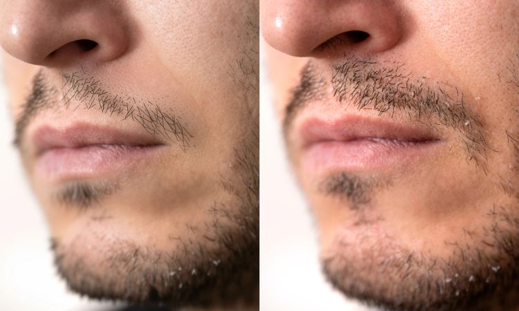 Moustache Transplant result