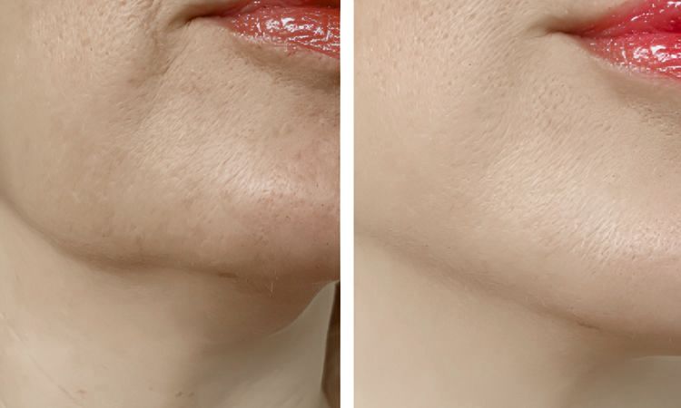 Profhilo Transformation