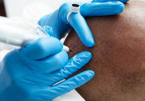 Scalp Micropigmentation process