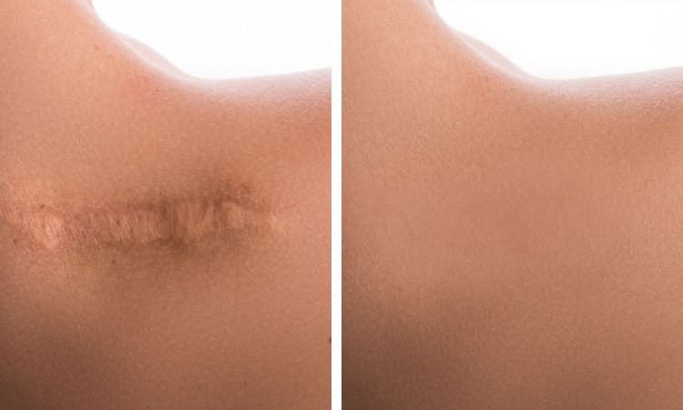 Scar Treatment