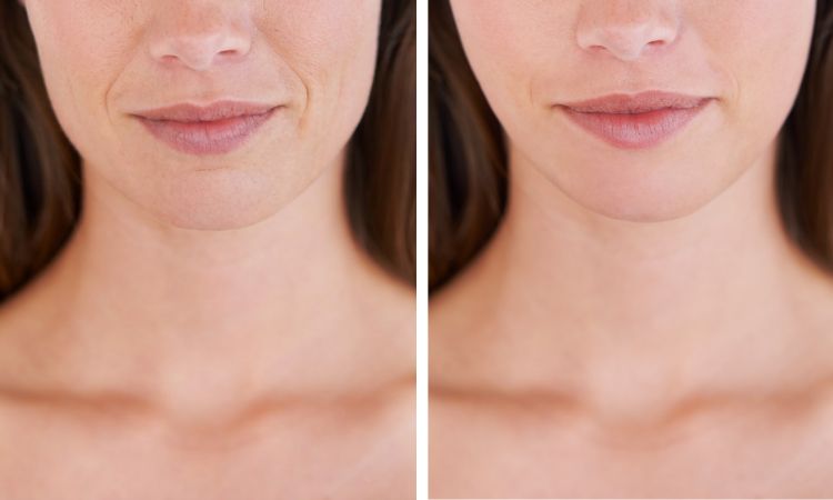 Thermage RF Transformation