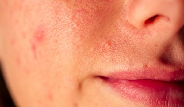 who needs the treatment