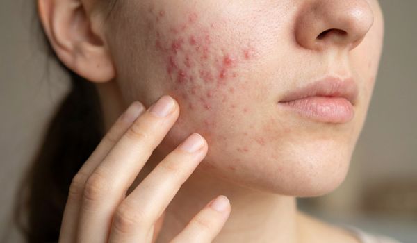 who needs the treatment