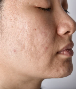 CO2 Laser Treatment in Kolkata | Elation Skin & Hair