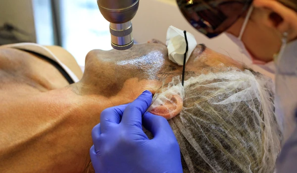 CO2 Laser Treatment in Kolkata | Elation Skin & Hair