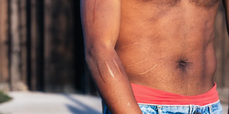 Scar Mark Revision Surgery | Elation Skin & Hair