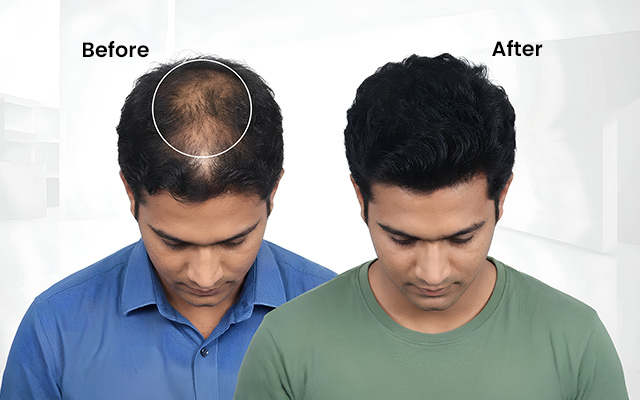 Hairline Vanishing in Your 30s? The Hair Transplant Trend Taking Over Kolkata Explained