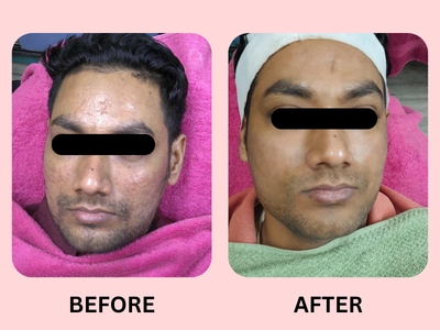 Acne-Scar Treatment Case 1