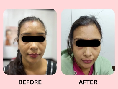 Carbon Facial Case 1