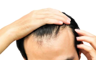 Dealing with Receding Hairline: What You Can Do to Regrow Your Hair Today
