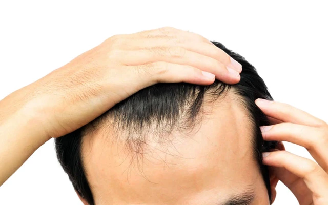 Dealing with Receding Hairline: What You Can Do to Regrow Your Hair Today