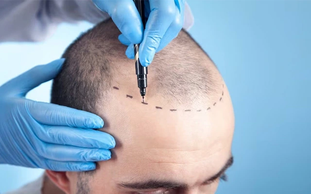 Is Hair Transplant Surgery Safe? Risks, Recovery, and Reality Check
