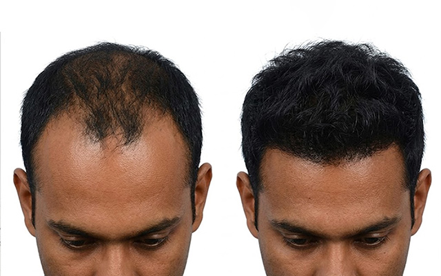 Modern Hair Restoration Procedures