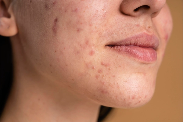 Acne & Acne Scar Treatment